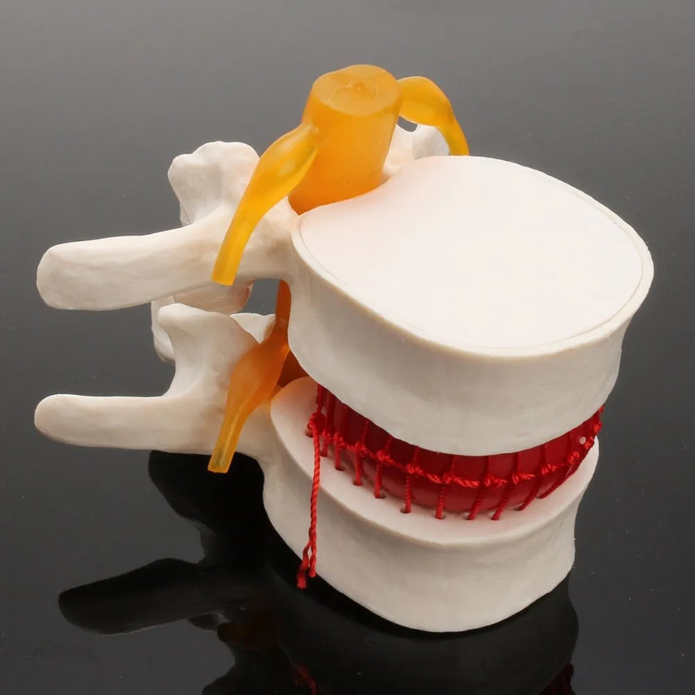 White PVC anatomical model of herniated lumbar intervertebral disc for medical demonstration