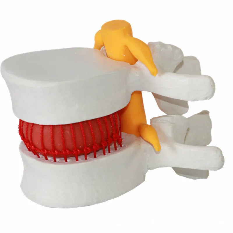 White PVC anatomical model of herniated lumbar intervertebral disc for medical demonstration