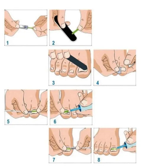 Nail patch kit with elastic posts, glue, debonding agent, alcohol wipes and pressing tools in a PP packing box