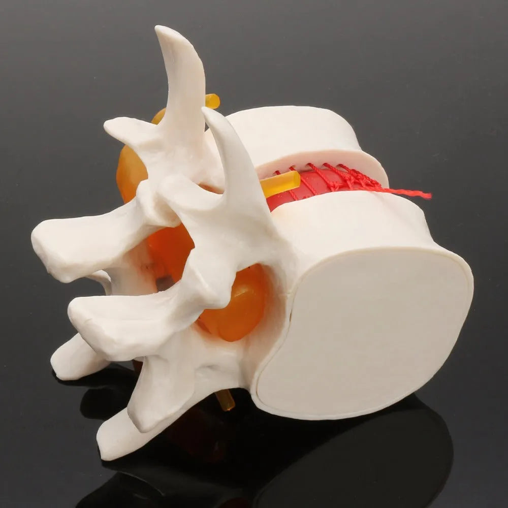 White PVC anatomical model of herniated lumbar intervertebral disc for medical demonstration