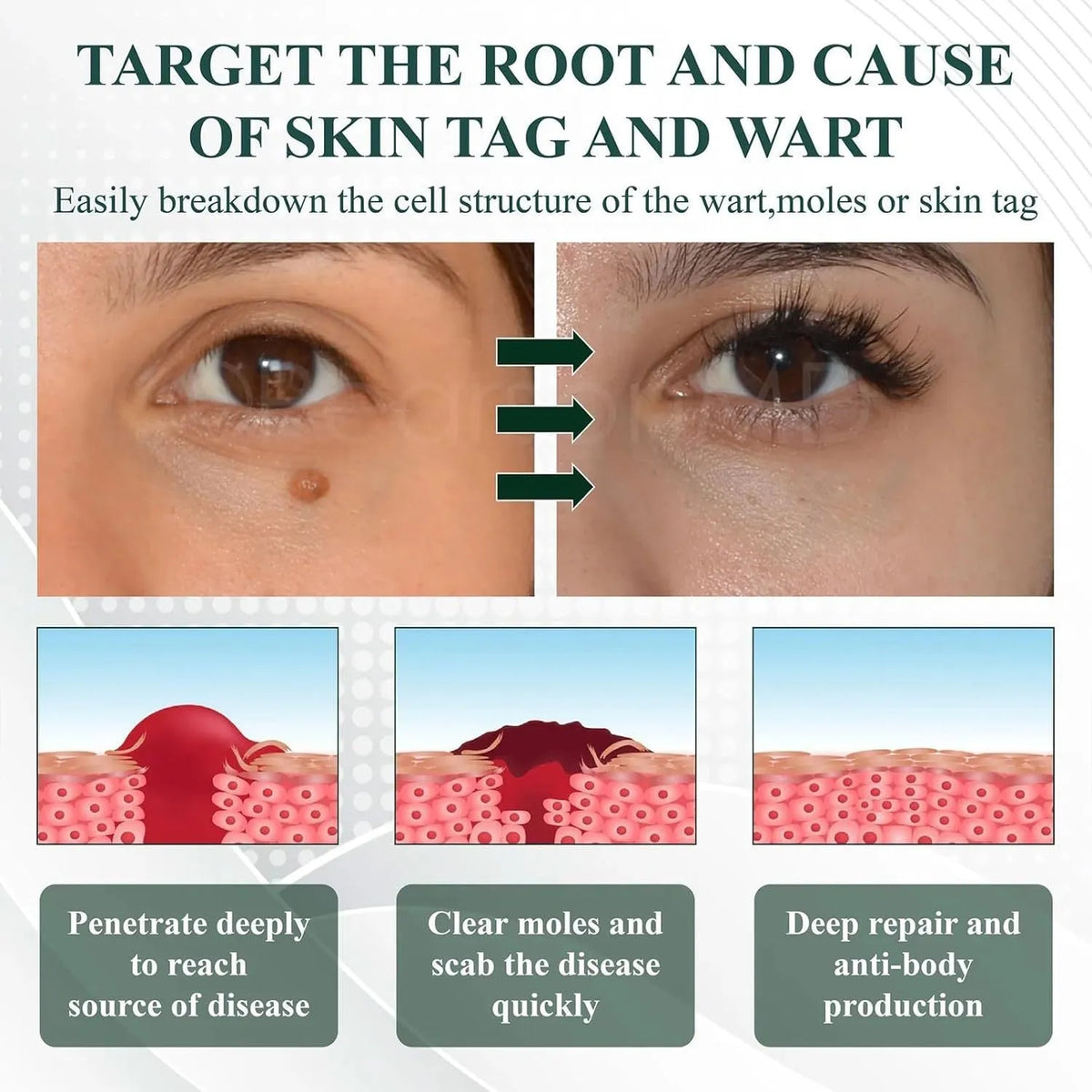 Natureerase Instant Mole Spot Removal Gel 45g hydrating body care gel for universal skin types