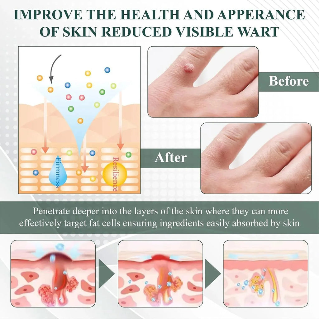 Natureerase Instant Mole Spot Removal Gel 45g hydrating body care gel for universal skin types