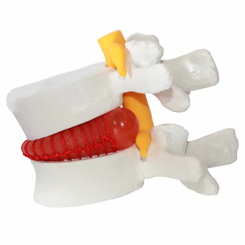 White PVC anatomical model of herniated lumbar intervertebral disc for medical demonstration