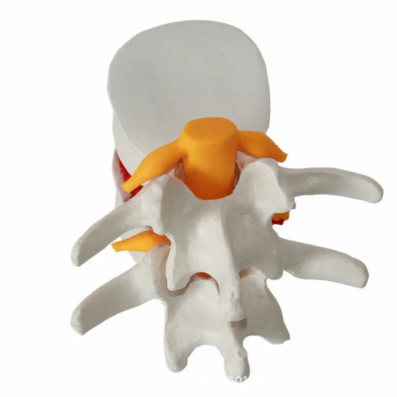 White PVC anatomical model of herniated lumbar intervertebral disc for medical demonstration