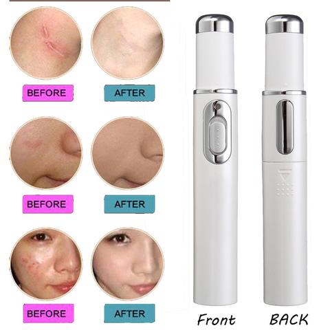 Blue Light Therapy Acne Laser Pen: Portable Scar & Wrinkle Removal Treatment Device for Flawless Skin Care Beauty Equipment
