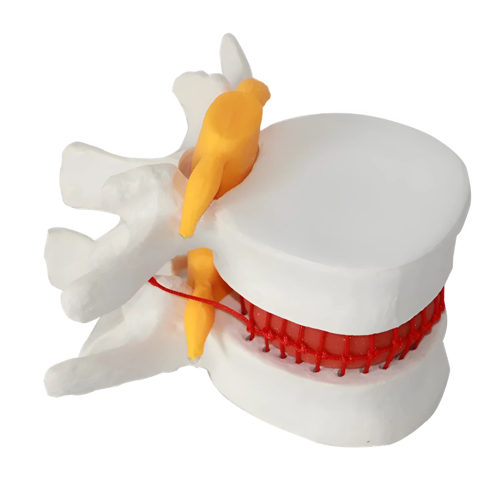 White PVC anatomical model of herniated lumbar intervertebral disc for medical demonstration