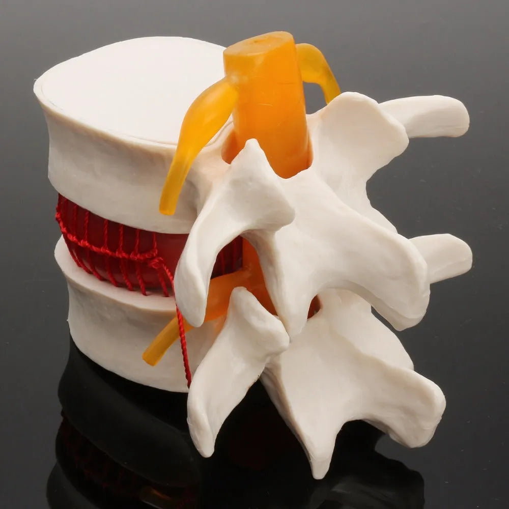 White PVC anatomical model of herniated lumbar intervertebral disc for medical demonstration