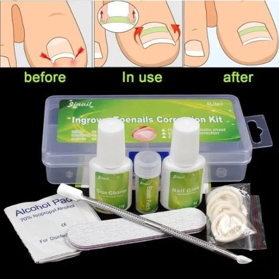 Nail patch kit with elastic posts, glue, debonding agent, alcohol wipes and pressing tools in a PP packing box