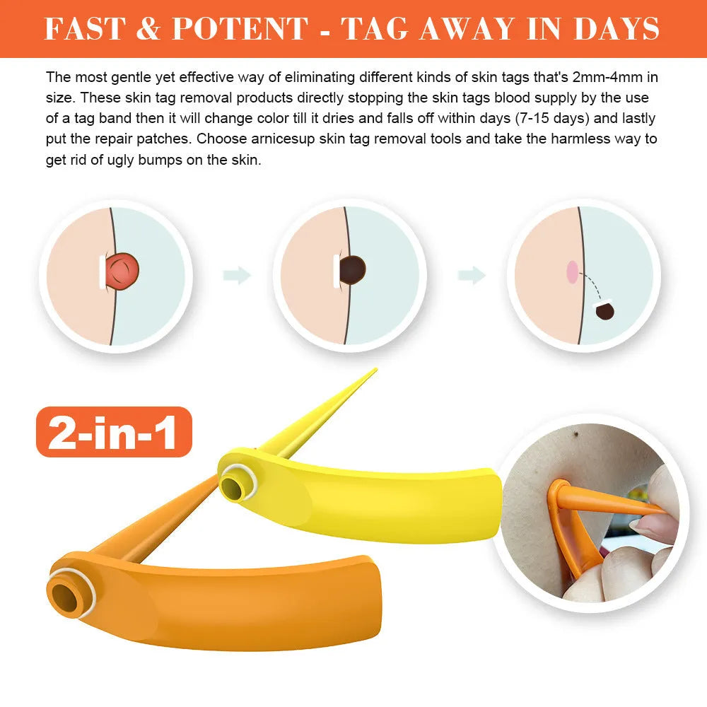 Orange-yellow mole remover kit with two devices, rubber rings, alcohol swabs, and manual.