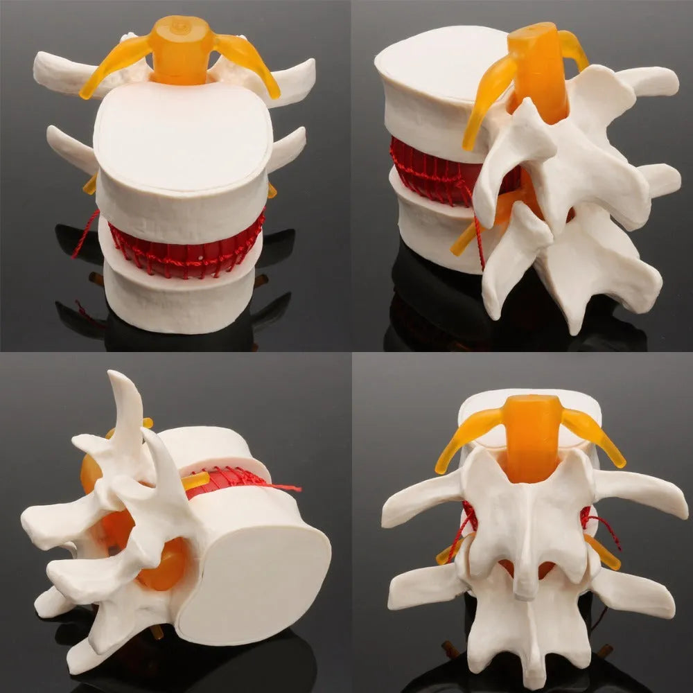 White PVC anatomical model of herniated lumbar intervertebral disc for medical demonstration