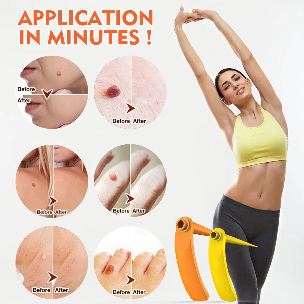 Orange-yellow mole remover kit with two devices, rubber rings, alcohol swabs, and manual.