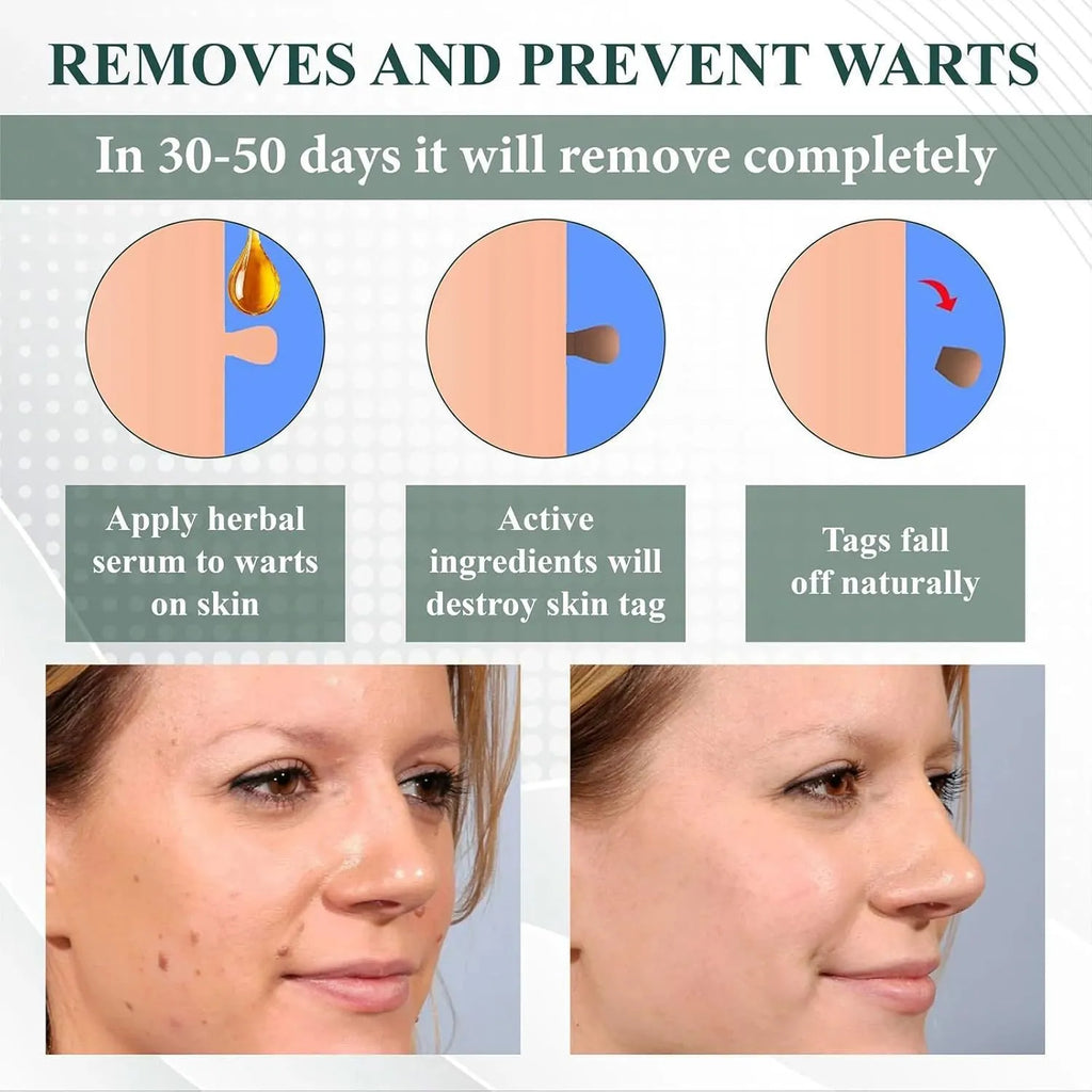 Natureerase Instant Mole Spot Removal Gel 45g hydrating body care gel for universal skin types