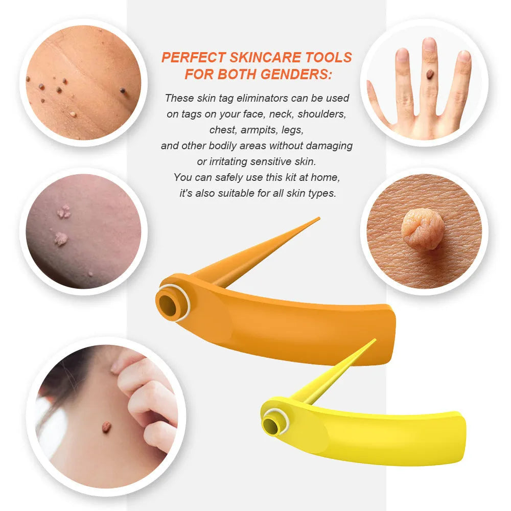 Orange-yellow mole remover kit with two devices, rubber rings, alcohol swabs, and manual.